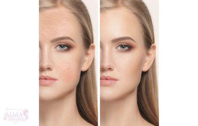 Acne treatments - Almas Laser Clinic