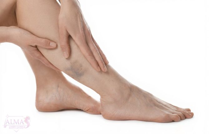 Varicose veins treatment - Almas Laser Clinic