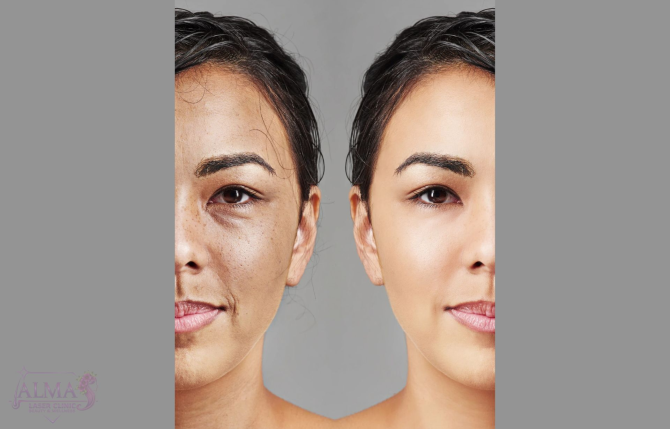 skin-rejuvenation-Almas-Laser-Clinic.webp